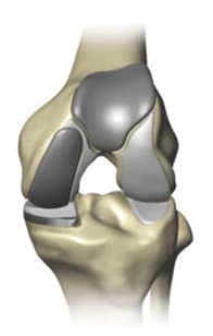 Biocompartmental knee replacement