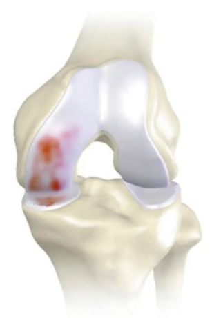 early stage knee illustration