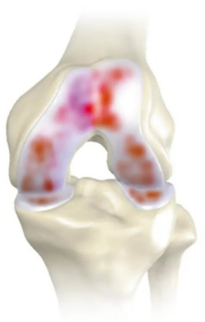 late stage knee illustration