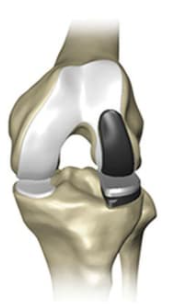 Lateral knee replacement