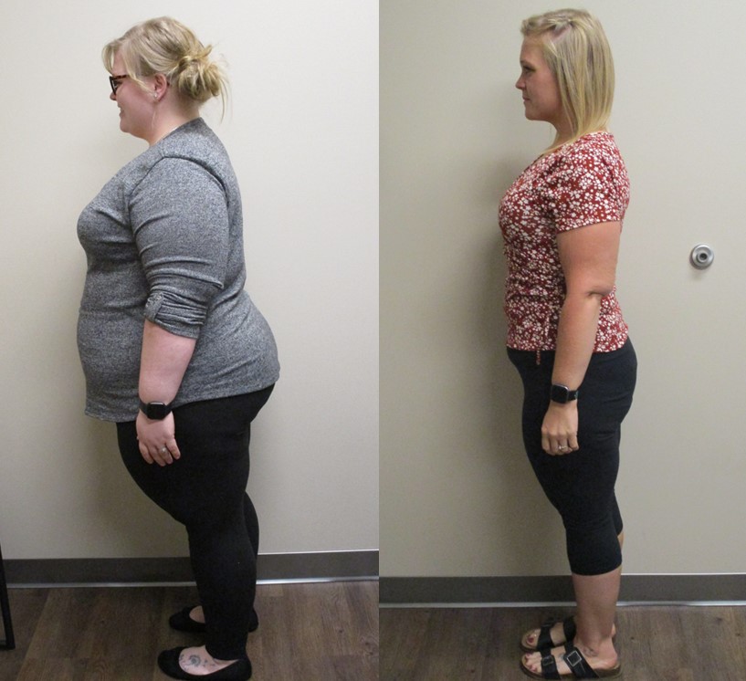 Gastric Bypass Before And After