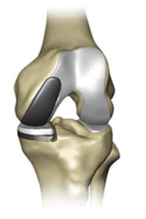 medial knee replacement