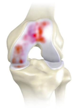 midstage knee illustration