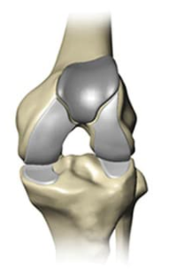 Patellofemoral knee replacement