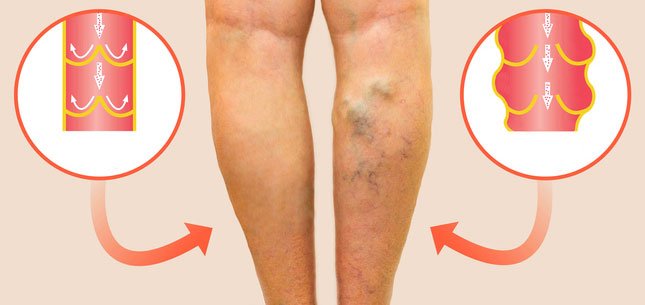 varicose veins and normal veins