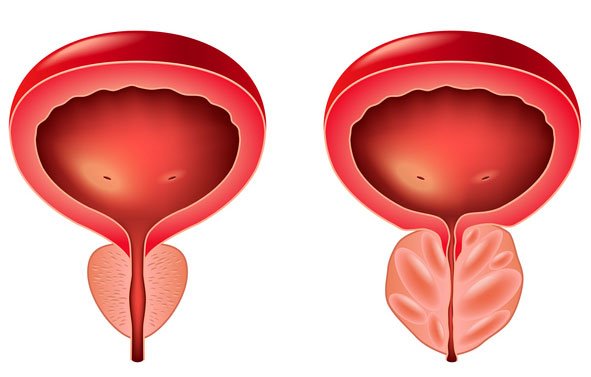 enlarged and normal prostate
