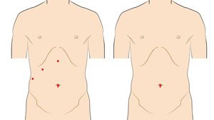 Multi-Incision Laparoscopy vs Single-Incision Robotic Surgery